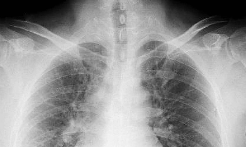 間質性肺炎とは自分の体の免疫細胞が引き起こす炎症のため、その