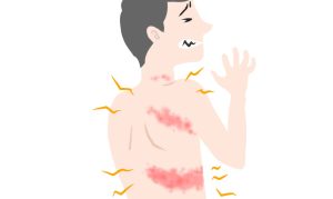 帯状疱疹を発症すると皮疹と痛みが出現します｜帯状疱疹ワクチン｜荒川区助成｜ぜんそくと肺のクリニック